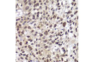 Immunohistochemistry of paraffin-embedded human lung cancer using CHEK2 antibody at dilution of 1:100 (400x lens). (CHEK2 Antikörper)