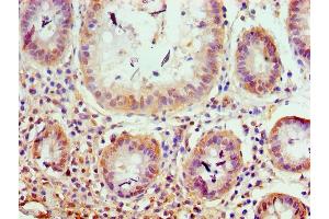Immunohistochemistry of paraffin-embedded human colon cancer using ABIN7176599 at dilution of 1:100 (TRIM27 Antikörper  (AA 214-513))