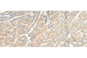Immunohistochemistry of paraffin-embedded Human liver cancer tissue using TTC4 Polyclonal Antibody at dilution of 1:45(x200)