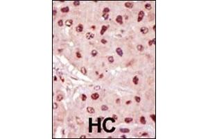 Formalin-fixed and paraffin-embedded human cancer tissue reacted with the primary antibody, which was peroxidase-conjugated to the secondary antibody, followed by DAB staining. (MEK1 Antikörper  (N-Term))