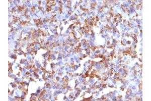 Formalin-fixed, paraffin-embedded human Histiocytoma stained with CD68 Mouse Monoclonal Antibody (LAMP4/824). (CD68 Antikörper)