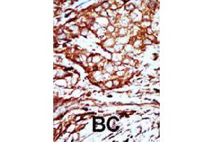 Formalin-fixed and paraffin-embedded human breast cancer tissue reacted with YWHAB polyclonal antibody  , which was peroxidase-conjugated to the secondary antibody, followed by AEC staining. (YWHAB Antikörper  (C-Term))
