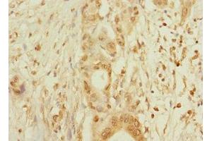 Immunohistochemistry of paraffin-embedded human pancreatic cancer using ABIN7160425 at dilution of 1:100 (MPZL2 Antikörper  (AA 30-140))