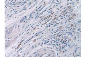 Detection of CDK2 in Human Colorectal cancer Tissue using Polyclonal Antibody to Cyclin Dependent Kinase 2 (CDK2) (CDK2 Antikörper  (AA 94-198))