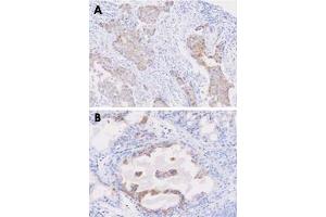 Paraffin embedded sections of human breast cancer (A) and prostate hyperplasia tissue (B) were incubated with STEAP1 monoclonal antibody, clone J2D2  (1 : 50) for 2 hours at room temperature. (STEAP1 Antikörper  (AA 1-70))