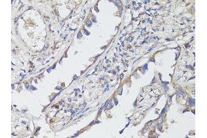 Immunohistochemistry of paraffin-embedded human lung cancer using NTRK2 antibody (ABIN6290695) at dilution of 1:200 (40x lens). (TRKB Antikörper)