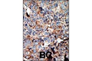 Formalin-fixed and paraffin-embedded human cancer tissue reacted with the primary antibody, which was peroxidase-conjugated to the secondary antibody, followed by AEC staining. (NME2 Antikörper  (N-Term))