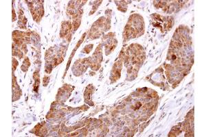 IHC-P Image TBCC antibody [N1C3] detects TBCC protein at cytosol on human breast carcinoma by immunohistochemical analysis. (TBCC Antikörper)