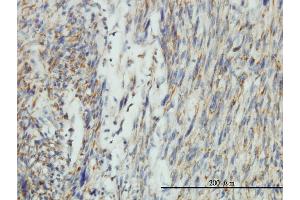 Immunoperoxidase of monoclonal antibody to DNM1L on formalin-fixed paraffin-embedded human leiomyosarcoma tissue. (Dynamin 1-Like Antikörper  (AA 1-710))