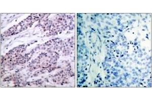 Immunohistochemistry analysis of paraffin-embedded human breast carcinoma tissue, using BCL-2 (Ab-56) Antibody. (Bcl-2 Antikörper  (AA 26-75))