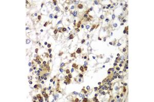 Immunohistochemistry of paraffin-embedded human kidney cancer using SND1 antibody (ABIN5973481) at dilution of 1/100 (40x lens). (SND1 Antikörper)