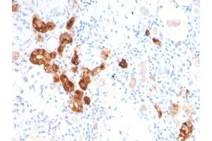 Formalin-fixed, paraffin-embedded human Kidney stained with Calbindin 1 Mouse Monoclonal Antibody (CALB1/2782). (CALB1 Antikörper  (AA 7-96))