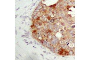 Immunohistochemical analysis of FAP alpha staining in human prostate cancer formalin fixed paraffin embedded tissue section. (FAP Antikörper)