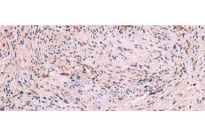 Immunohistochemistry of paraffin-embedded Human cervical cancer tissue using MBTPS2 Polyclonal Antibody at dilution of 1:30(x200) (MBTPS2 Antikörper)