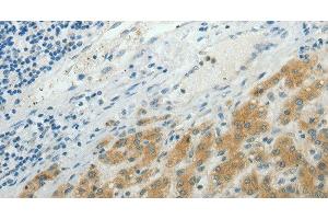 Immunohistochemistry of paraffin-embedded Human liver cancer using NDRG2 Polyclonal Antibody at dilution of 1:50 (NDRG2 Antikörper)