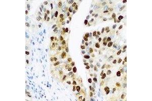 Immunohistochemical analysis of PHC1 staining in human prostate formalin fixed paraffin embedded tissue section.