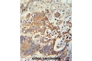 CHCHD2 antibody (Center) immunohistochemistry analysis in formalin fixed and paraffin embedded human colon carcinoma followed by peroxidase conjugation of the secondary antibody and DAB staining. (CHCHD2 Antikörper  (Middle Region))