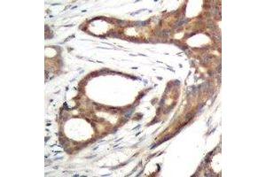 Immunohistochemical analysis of PER2 (pS662) staining in human prostate cancer formalin fixed paraffin embedded tissue section. (PER2 Antikörper  (pSer662))
