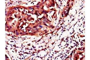 Immunohistochemistry of paraffin-embedded human bladder cancer using ABIN7162131 at dilution of 1:100 (Uncharacterized Protein C4orf26 (ODAPH) (AA 24-130) Antikörper)