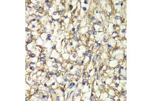 Immunohistochemistry of paraffin-embedded human kidney cancer using PTGES2 antibody (ABIN5974292) at dilution of 1/100 (40x lens). (PTGES2 Antikörper)