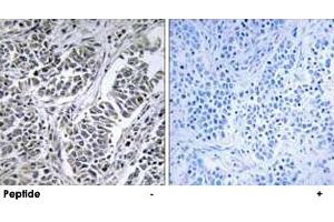 Immunohistochemistry analysis of paraffin-embedded human lung carcinoma tissue using ATP5D polyclonal antibody .