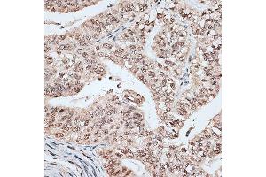 Immunohistochemistry of paraffin-embedded human endometrium cancer using RBM17 antibody (ABIN6133103, ABIN6146765, ABIN6146766 and ABIN6220171) at dilution of 1:100 (40x lens). (RBM17 Antikörper  (AA 1-240))