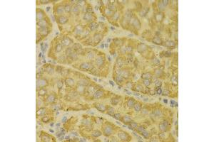 Immunohistochemistry of paraffin-embedded human liver cancer using MAOA antibody (ABIN5970633) at dilution of 1/100 (40x lens). (Monoamine Oxidase A Antikörper)