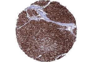 Squamous cell carcinoma of the esophagus showing a Cystatin A immunostaining of all tumor cells (CSTA Antikörper)