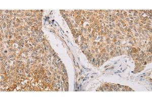 Immunohistochemistry of paraffin-embedded Human lung cancer tissue using STK40 Polyclonal Antibody at dilution 1:40 (STK40 Antikörper)