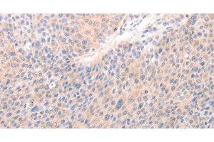 Immunohistochemistry of paraffin-embedded Human liver cancer tissue using ACO1 Polyclonal Antibody at dilution 1:50 (Aconitase 1 Antikörper)
