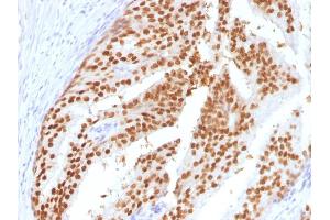 Formalin-fixed, paraffin-embedded human Prostate (PIN) stained with FOXA1 Mouse Monoclonal Antibody (FOXA1/1516). (FOXA1 Antikörper  (AA 372-472))
