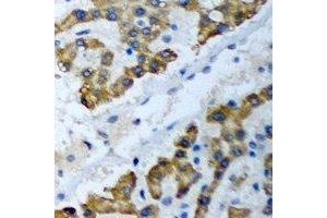 Immunohistochemical analysis of PSMF1 staining in human liver cancer formalin fixed paraffin embedded tissue section.