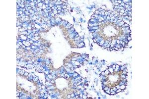 Immunohistochemistry of paraffin-embedded Human colon carcinoma using MMP16 Polyclonal Antibody at dilution of 1:100 (40x lens).