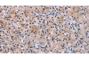 Immunohistochemistry of paraffin-embedded Human prostate cancer using SLC1A6 Polyclonal Antibody at dilution of 1:40 (SLC1A6 Antikörper)