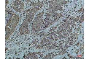 Immunohistochemistry (IHC) analysis of paraffin-embedded Human Breast Carcicnoma using GRP78/Bip Mouse Monoclonal Antibody diluted at 1:200. (GRP78 Antikörper)