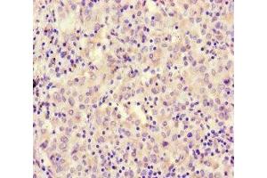 Immunohistochemistry of paraffin-embedded human lung cancer using ABIN7167721 at dilution of 1:100 (CoREST Antikörper  (AA 394-482))