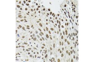 Immunohistochemistry of paraffin-embedded human lung cancer using SFPQ antibody (ABIN5970351) at dilution of 1/100 (40x lens). (SFPQ Antikörper)