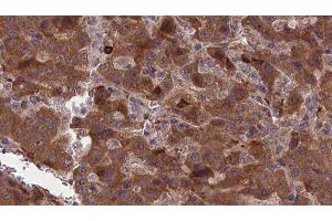 ABIN6277317 at 1/100 staining Human liver cancer tissue by IHC-P. (CNTF Receptor alpha Antikörper  (Internal Region))