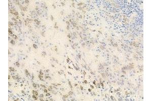 ABIN6262527 and ABIN6278482 at 1/100 staining human melanoma by IHC-P. (IL32 Antikörper  (Internal Region))