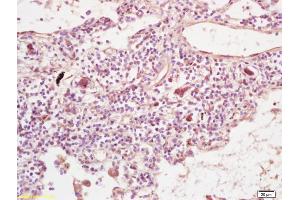 Formalin-fixed and paraffin embedded human lung carcinoma labeled with Rabbit Anti PLEKHM2/SKIP Polyclonal Antibody, Unconjugated (ABIN872446) at 1:200 followed by conjugation to the secondary antibody and DAB staining (PLEKHM2 Antikörper  (AA 688-750))