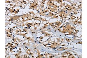 The image on the left is immunohistochemistry of paraffin-embedded Human thyroid cancer tissue using ABIN7190315(CMTM8 Antibody) at dilution 1/40, on the right is treated with synthetic peptide.