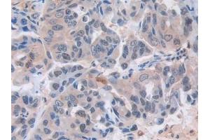 Detection of MX1 in Human Breast cancer Tissue using Polyclonal Antibody to Myxovirus Resistance 1 (MX1) (MX1 Antikörper  (AA 80-342))