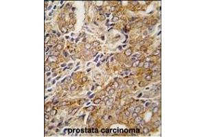 Formalin-fixed and paraffin-embedded human prostata carcinoma tissue reacted with TR antibody (C-term ) (ABIN392821 and ABIN2842253) , which was peroxidase-conjugated to the secondary antibody, followed by DAB staining. (TRPM8 Antikörper  (C-Term))