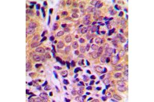 Immunohistochemical analysis of 4EBP1 (pT46) staining in human breast cancer formalin fixed paraffin embedded tissue section. (eIF4EBP1 Antikörper  (N-Term, pSer46))