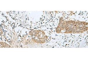 Immunohistochemistry of paraffin-embedded Human esophagus cancer tissue using SNRPD1 Polyclonal Antibody at dilution of 1:70(x200) (SNRPD1 Antikörper)