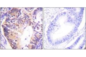 Immunohistochemistry analysis of paraffin-embedded human colon carcinoma tissue, using PAK1 (Ab-212) Antibody. (PAK1 Antikörper  (AA 178-227))