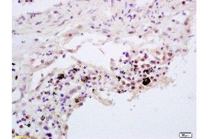 Formalin-fixed and paraffin embedded human lung carcinoma labeled with Rabbit Anti TNFAIP3/A20 Polyclonal Antibody, Unconjugated  at 1:200 followed by conjugation to the secondary antibody and DAB staining (TNFAIP3 Antikörper  (AA 51-150))