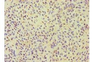 Immunohistochemistry of paraffin-embedded human breast cancer using ABIN7155980 at dilution of 1:100