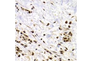 Immunohistochemistry of paraffin-embedded human kidney cancer using SUMO4 Antibody (ABIN5971586) at dilution of 1/200 (40x lens).