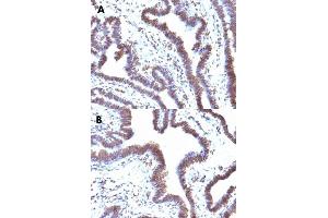 Immunohistochemical staining (Formalin-fixed paraffin-embedded sections) of human ovarian cancer (A, B) with FBXO5 monoclonal antibody, clone EMI1/1176 . (FBXO5 Antikörper  (AA 1-250))